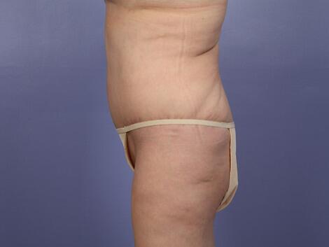 Tummy Tuck Before & After Image