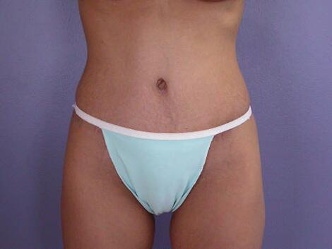 Tummy Tuck Before & After Image