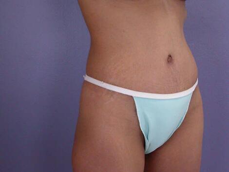 Tummy Tuck Before & After Image