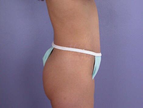 Tummy Tuck Before & After Image