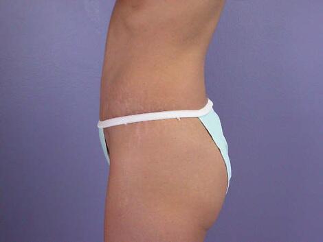 Tummy Tuck Before & After Image