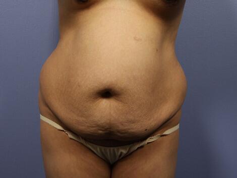 Tummy Tuck Before & After Image