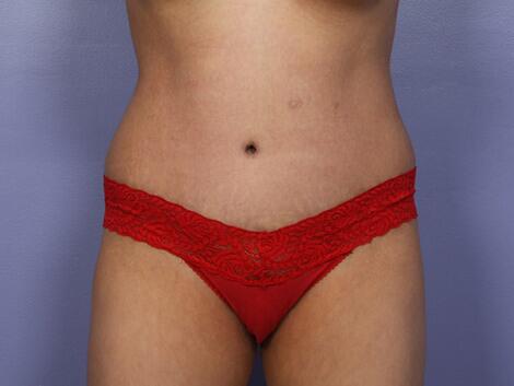 Tummy Tuck Before & After Image