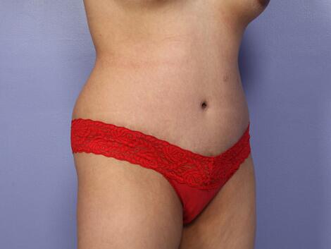 Tummy Tuck Before & After Image