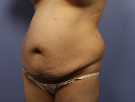 Tummy Tuck Before & After Image