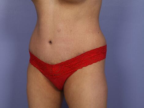 Tummy Tuck Before & After Image