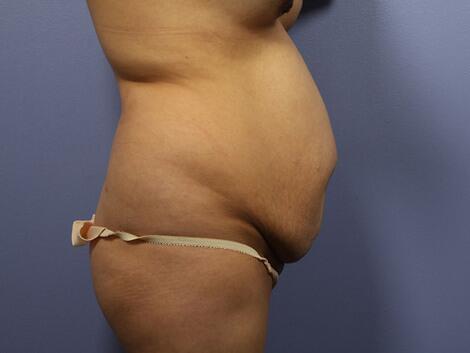 Tummy Tuck Before & After Image