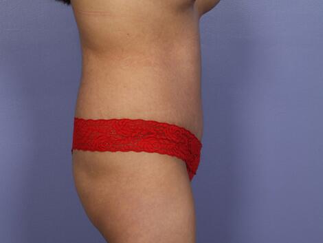 Tummy Tuck Before & After Image