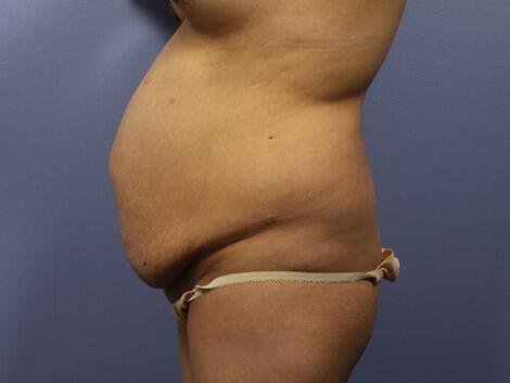 Tummy Tuck Before & After Image