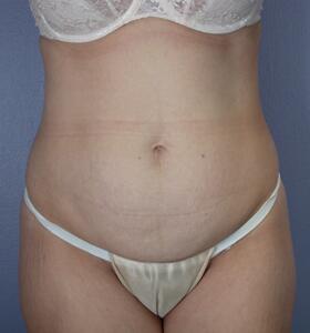 Tummy Tuck Before & After Image