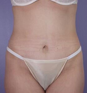 Tummy Tuck Before & After Image