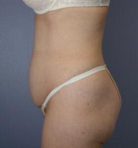 Tummy Tuck Before & After Image