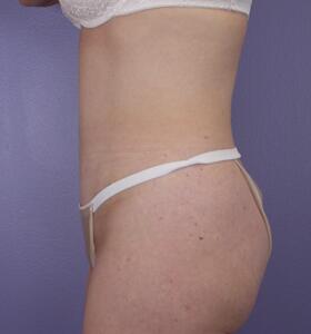 Tummy Tuck Before & After Image