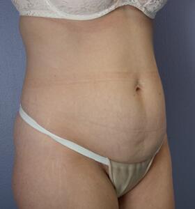 Tummy Tuck Before & After Image