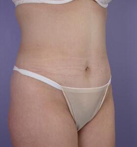 Tummy Tuck Before & After Image