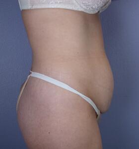 Tummy Tuck Before & After Image