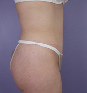 Tummy Tuck Before & After Image