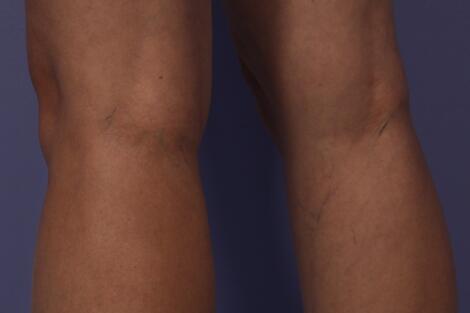 Vein Treatment Before & After Image