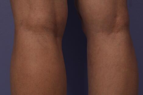 Vein Treatment Before & After Image