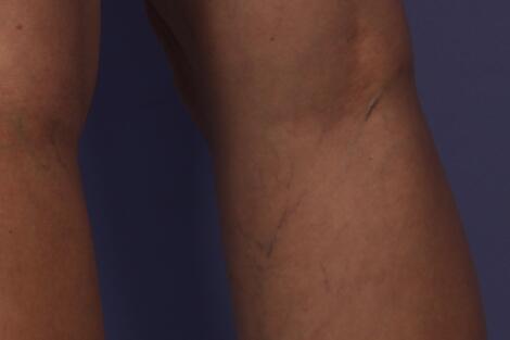 Vein Treatment Before & After Image