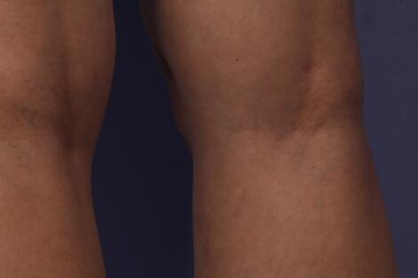 Vein Treatment Before & After Image