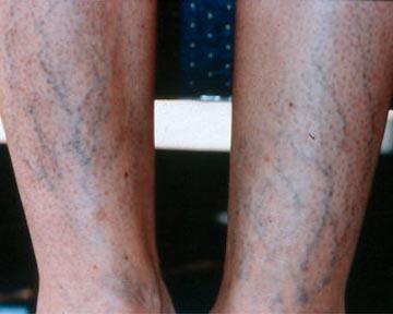 Vein Treatment Before & After Image