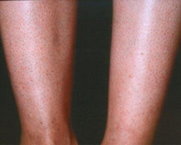 Vein Treatment Before & After Image