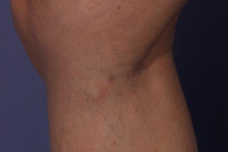 Vein Treatment Before & After Image