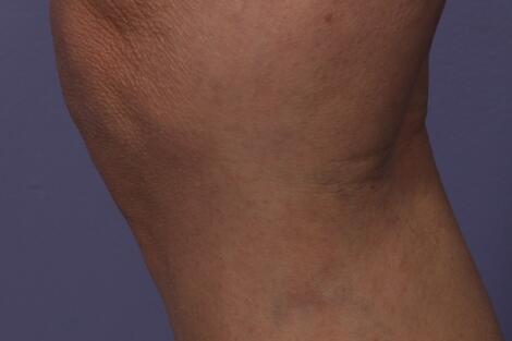 Vein Treatment Before & After Image