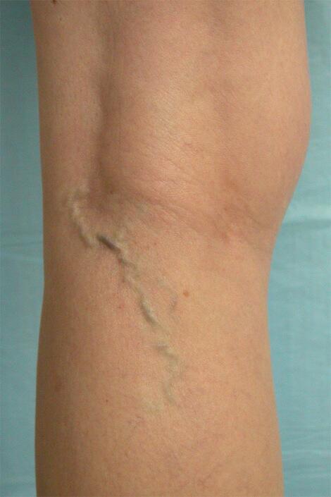 Vein Treatment Before & After Image