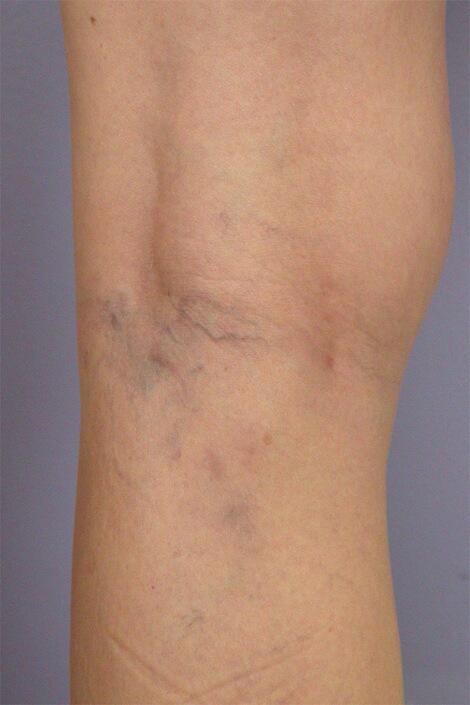 Vein Treatment Before & After Image