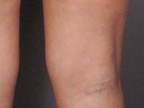 Vein Treatment Before & After Image