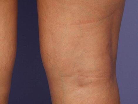 Vein Treatment Before & After Image