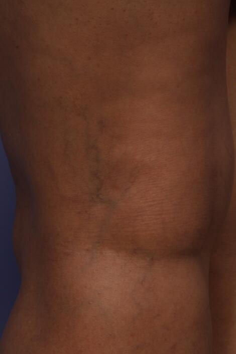 Vein Treatment Before & After Image