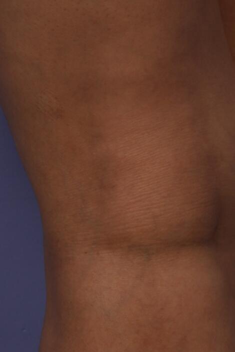 Vein Treatment Before & After Image