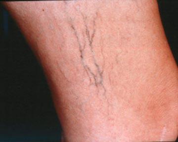 Vein Treatment Before & After Image