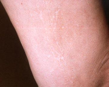 Vein Treatment Before & After Image