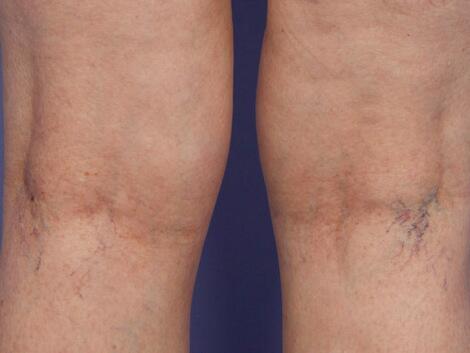 Vein Treatment Before & After Image