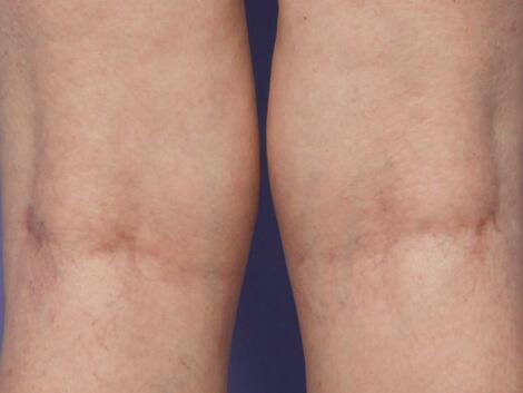 Vein Treatment Before & After Image