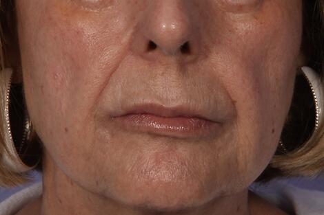 Wrinkle Reduction Before & After Image