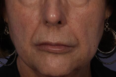 Wrinkle Reduction Before & After Image