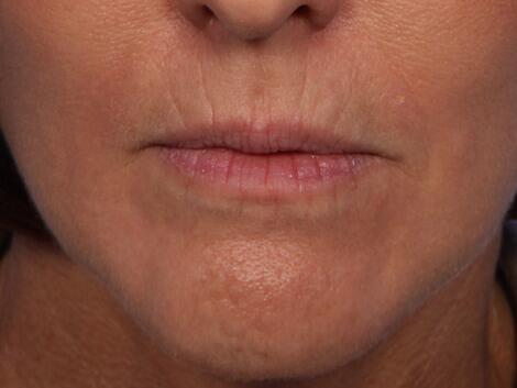 Wrinkle Reduction Before & After Image