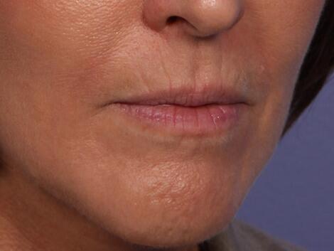 Wrinkle Reduction Before & After Image