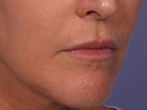 Wrinkle Reduction Before & After Image