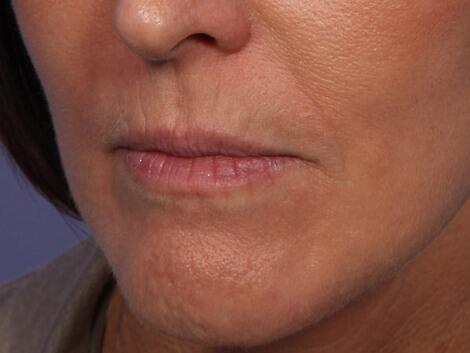 Wrinkle Reduction Before & After Image