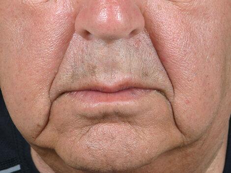 Wrinkle Reduction Before & After Image