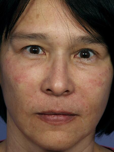 Wrinkle Reduction Before & After Image