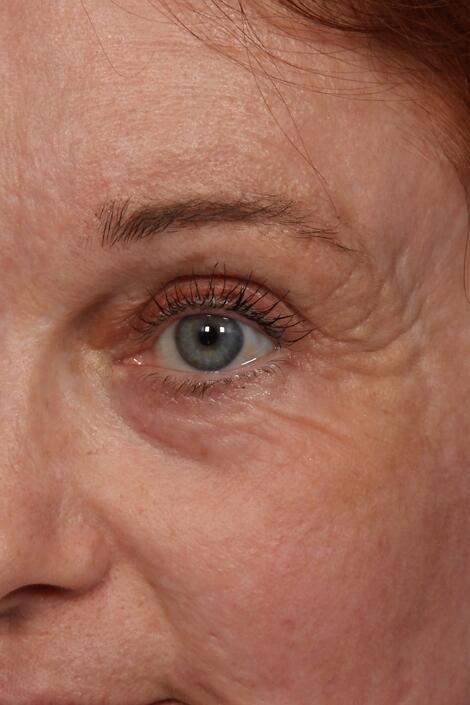 Wrinkle Reduction Before & After Image