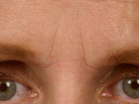 Wrinkle Reduction Before & After Image