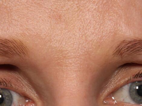 Wrinkle Reduction Before & After Image